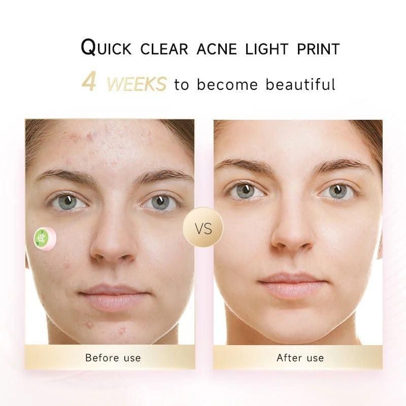 Electronic Acne Patches 6pcs